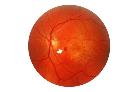 makulato|Macular degeneration